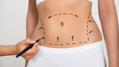 Liposuction Surgery in Dubai