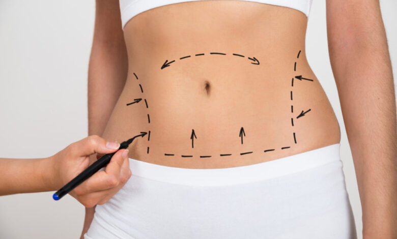 Liposuction Surgery in Dubai