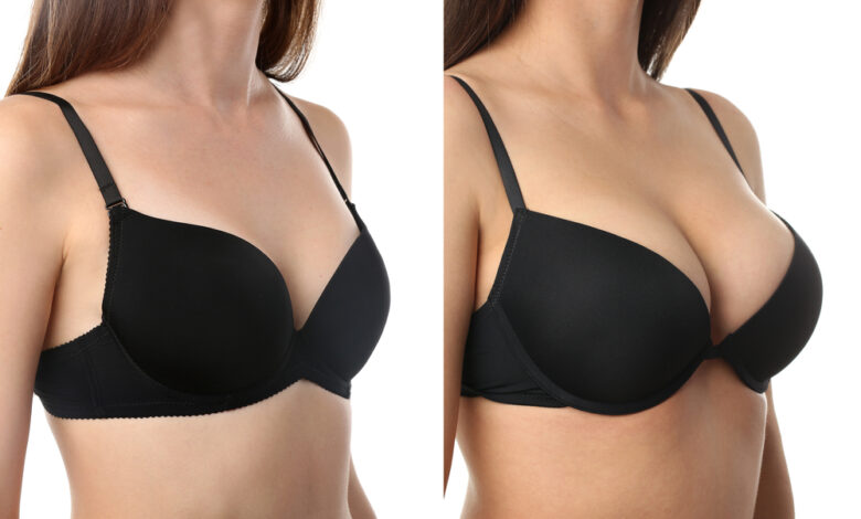 What kind of results can I realistically expect from breast augmentation