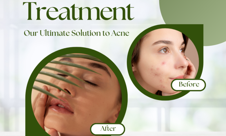 Is Permanent Acne Removal Possible? Here’s the Best Way