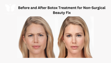 before and after botox treatment