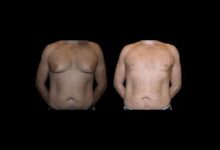 Before and After Male Breast Reduction Results