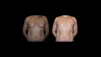 Before and After Male Breast Reduction Results