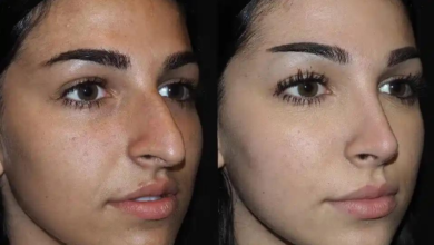 What is Liquid Rhinoplasty in Dubai?