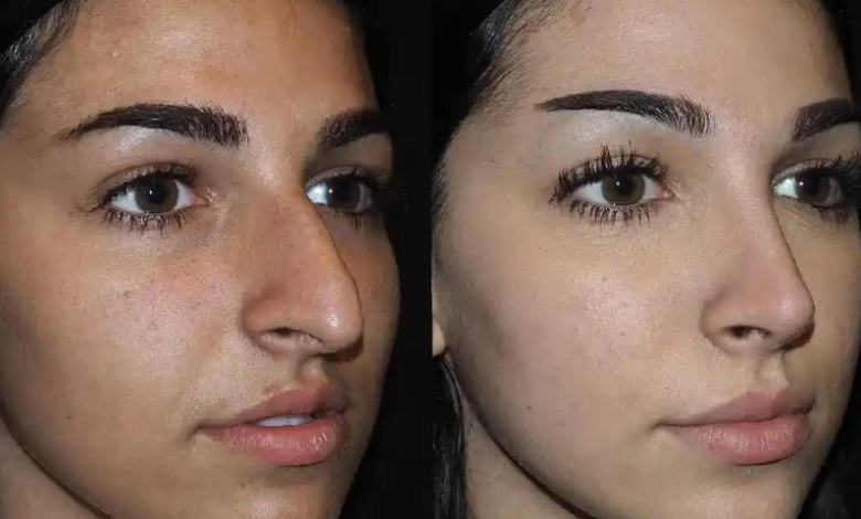 What is Liquid Rhinoplasty in Dubai?