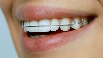 Benefits of Wearing Dental Retainers After Orthodontic Treatment