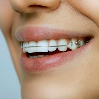 Benefits of Wearing Dental Retainers After Orthodontic Treatment