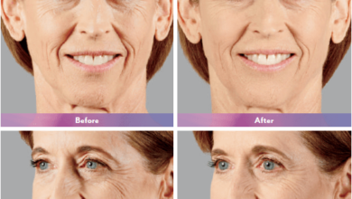 Juvéderm Treatment in Novi