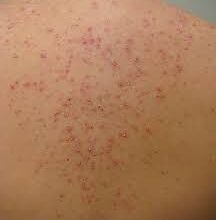 Levofloxacin for Skin Infections