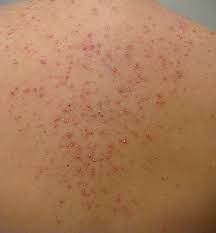 Levofloxacin for Skin Infections