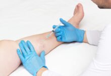 do spider veins come back after laser treatment