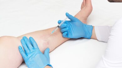 do spider veins come back after laser treatment