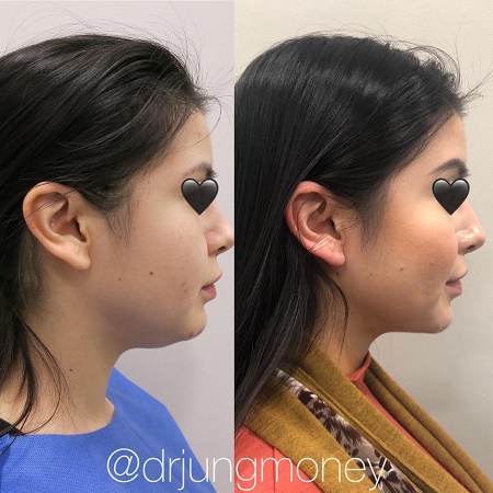 eyelid surgery cost