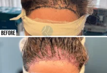 best hair transplant in pakistan