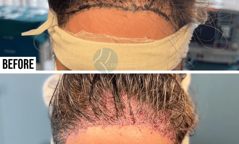 best hair transplant in pakistan