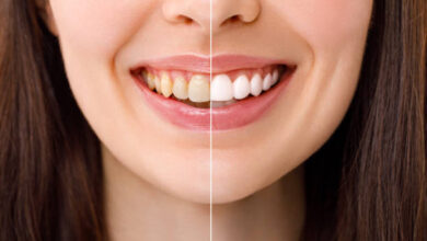 Teeth Whitening in Riyadh