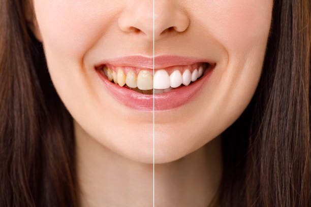 Teeth Whitening in Riyadh