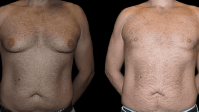 male breast reduction in dubai