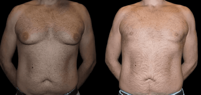 male breast reduction in dubai