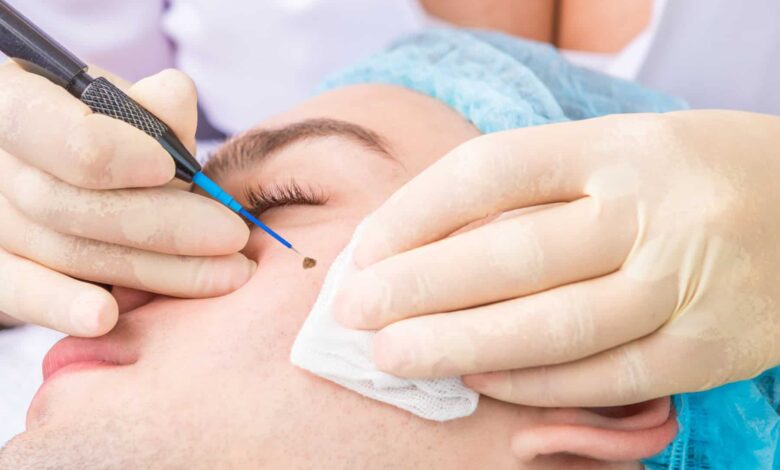 Spot-Free Confidence: Expert Mole Removal in London