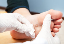 wart removal sydney