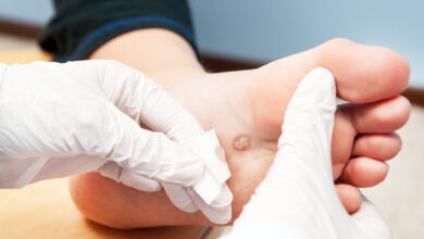 wart removal sydney