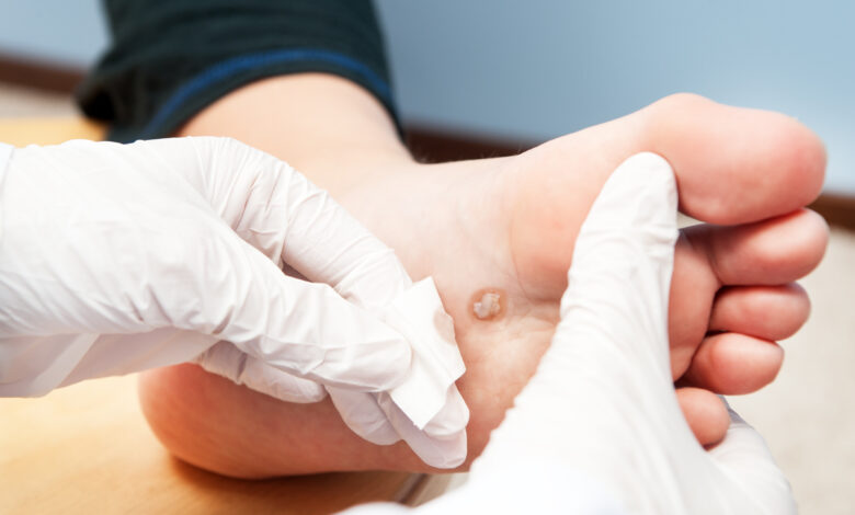 wart removal sydney